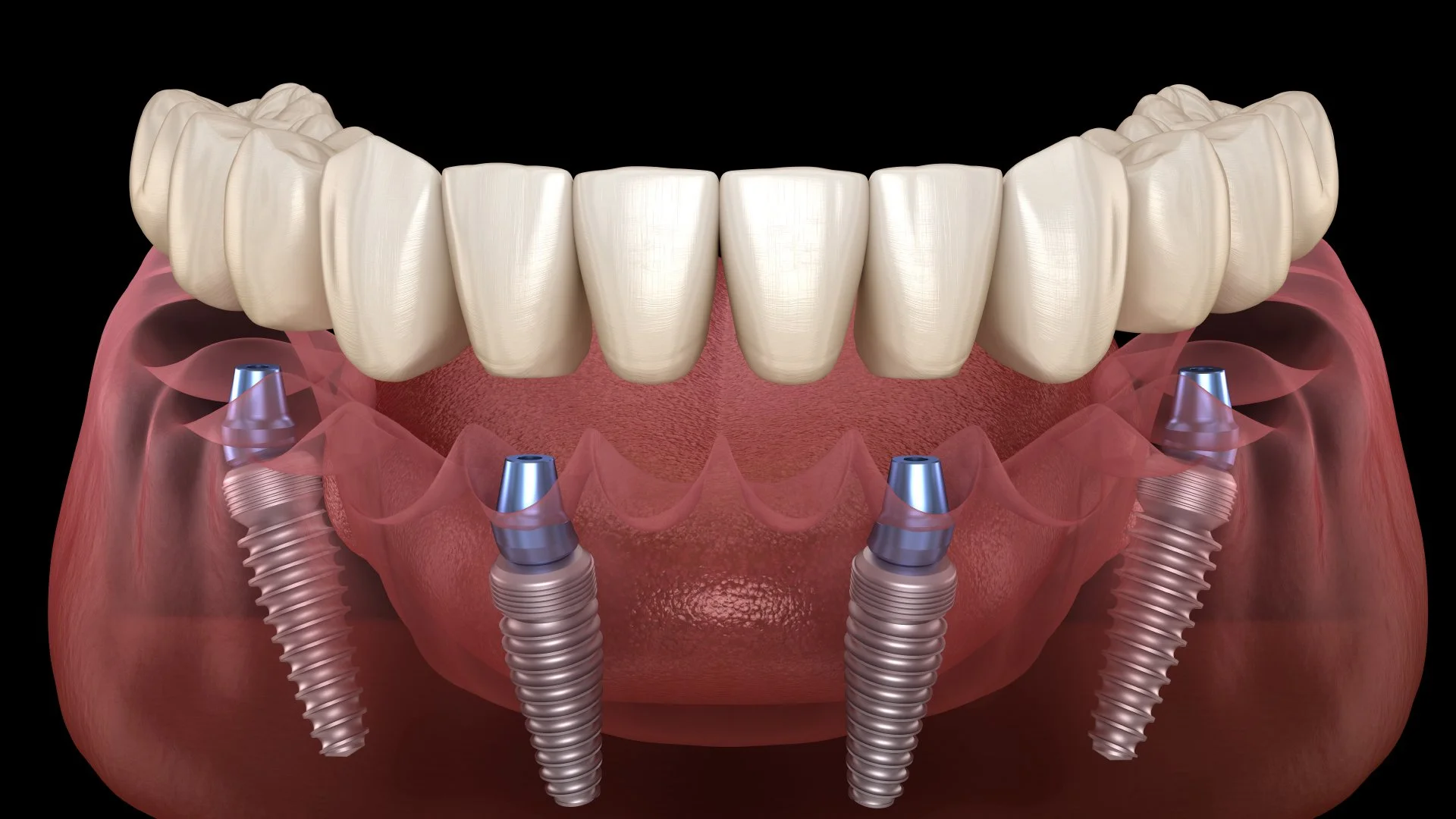 Digital illustration of dental implants with a lower jaw showing four metal fixtures embedded in gums and teeth above.