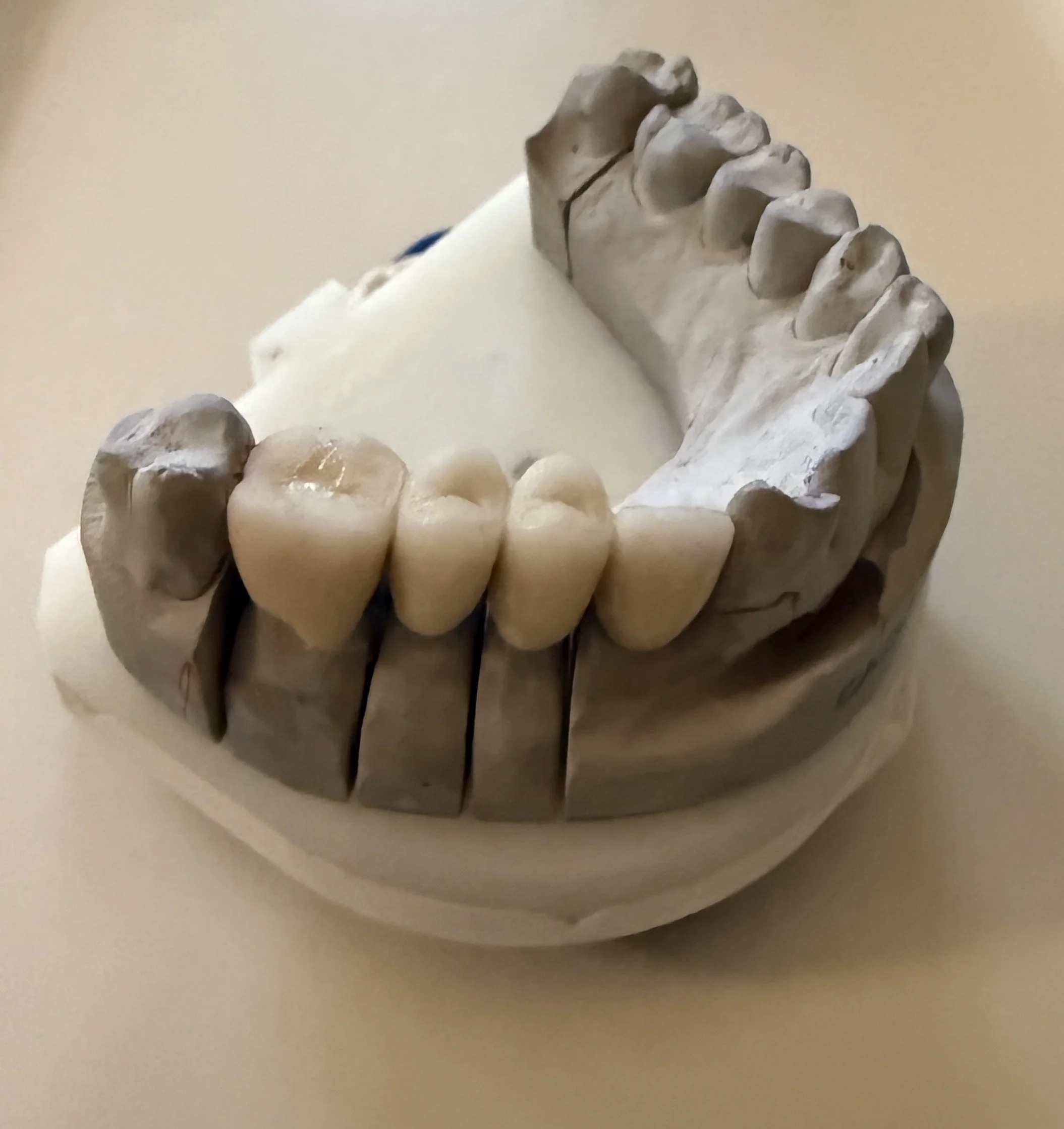 A dental plaster model showing upper and lower teeth, with some artificial teeth.