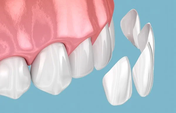 Close-up of broken white dental veneers or crowns falling away from pink gums against a light blue background.