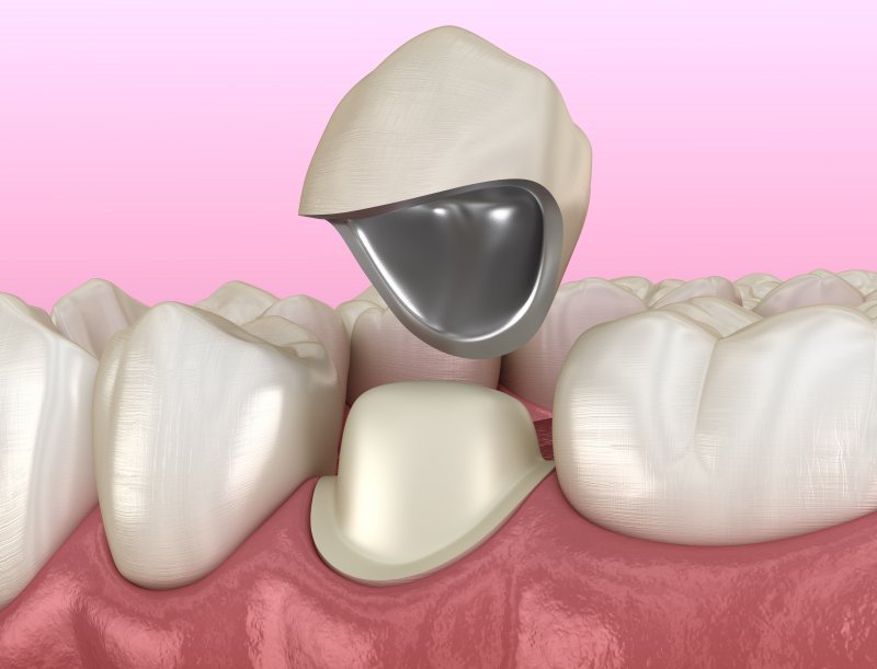 A dental crown being placed onto a prepared tooth in a patient's mouth, with surrounding teeth and pink gum tissue visible.