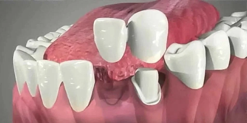 Display of a dental model showing missing and damaged teeth with some crowns and dental prosthetics.