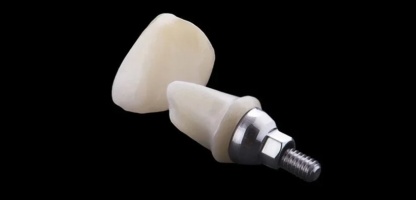 A dental implant with a ceramic crown against a black background.