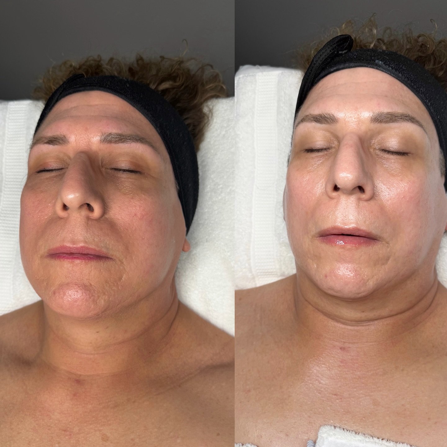 A gentle treatment that removes dead skin cells and peach fuzz using a sterile blade. This helps reveal smoother, brighter skin and allows skincare products to absorb better. Your skin will feel soft, fresh, and glowing, and makeup will apply more sm