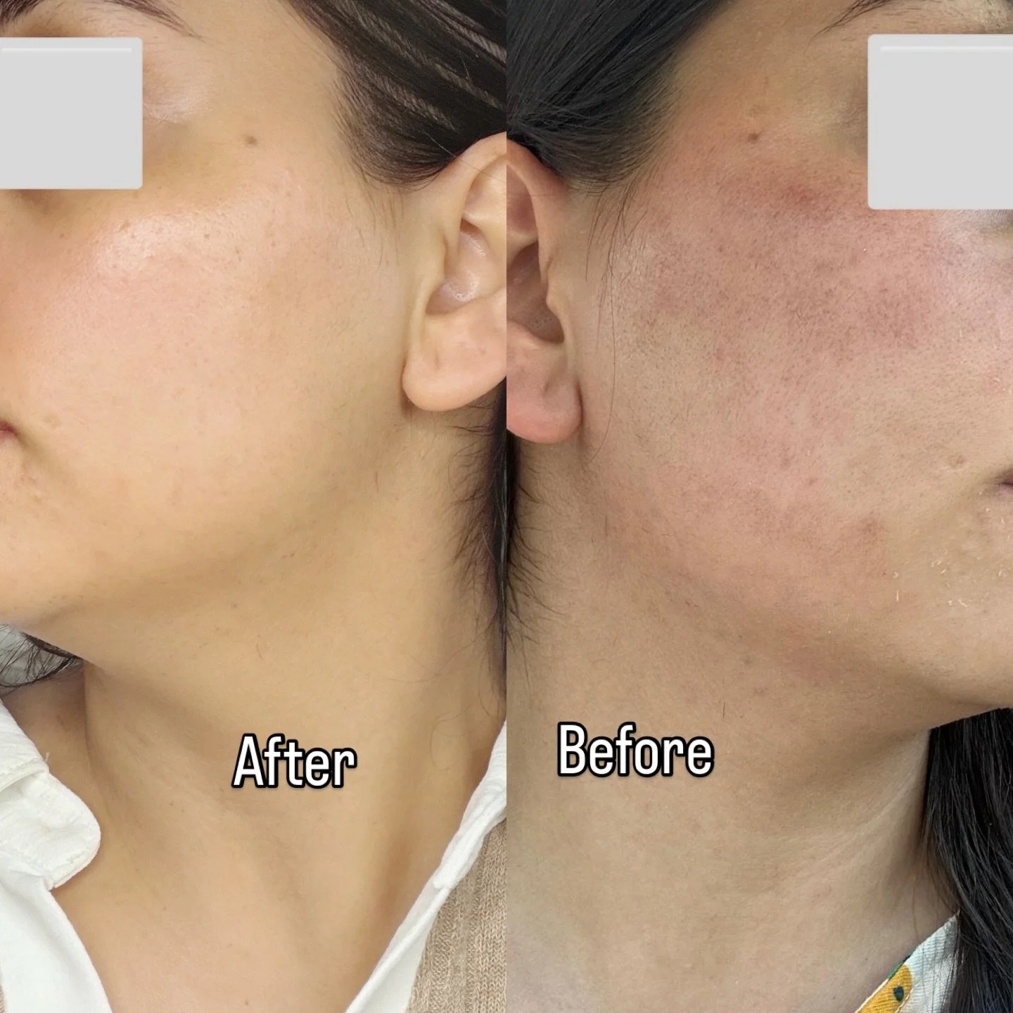 ☘️one treatment of BioRepeel ☘️. This transformation was achieved with BioRePeels, one of my favorite treatments for improving:
&bull; hyperpigmentation
&bull; acne + congestion
&bull; uneven skin texture
BioRePeel works by gently exfoliating the ski