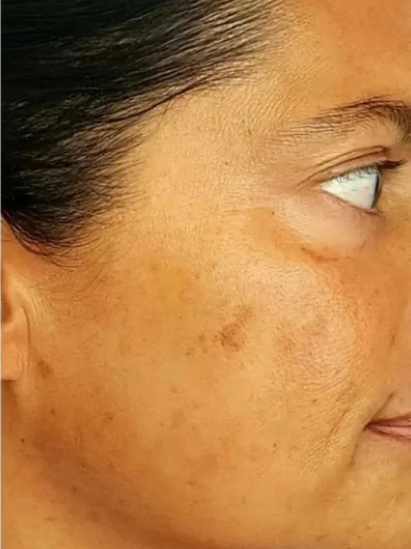 Close-up of a woman's face showing skin with freckles and uneven pigmentation.