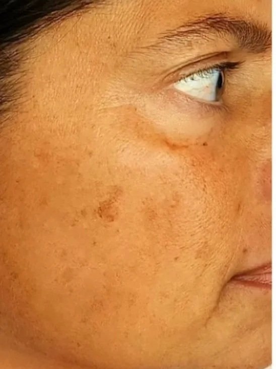 Close-up of a person's face showing skin with hyperpigmentation, freckles, and some slight scarring.