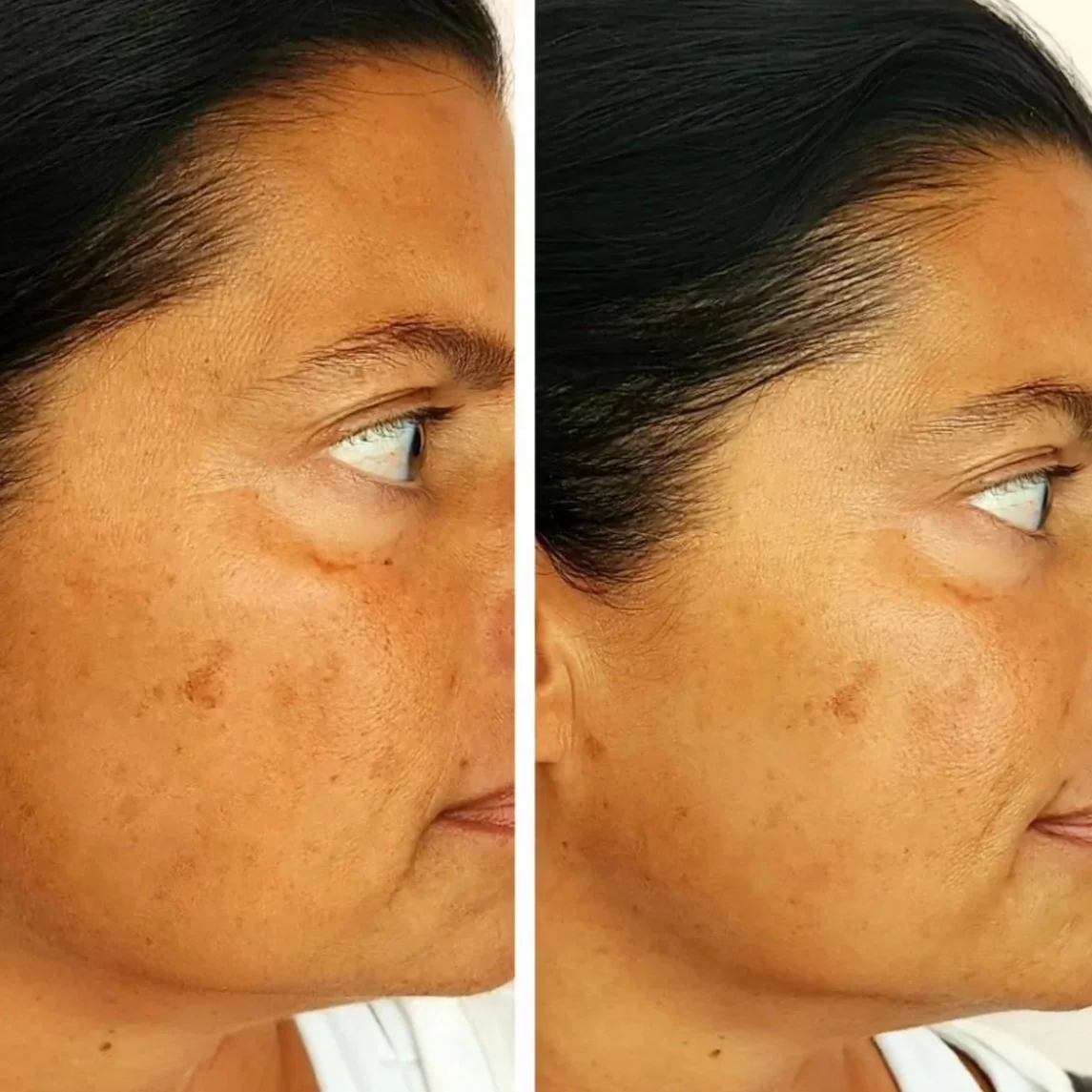 Comparison image showing a woman's face before and after skincare treatment, with improved skin texture and reduced dark spots.