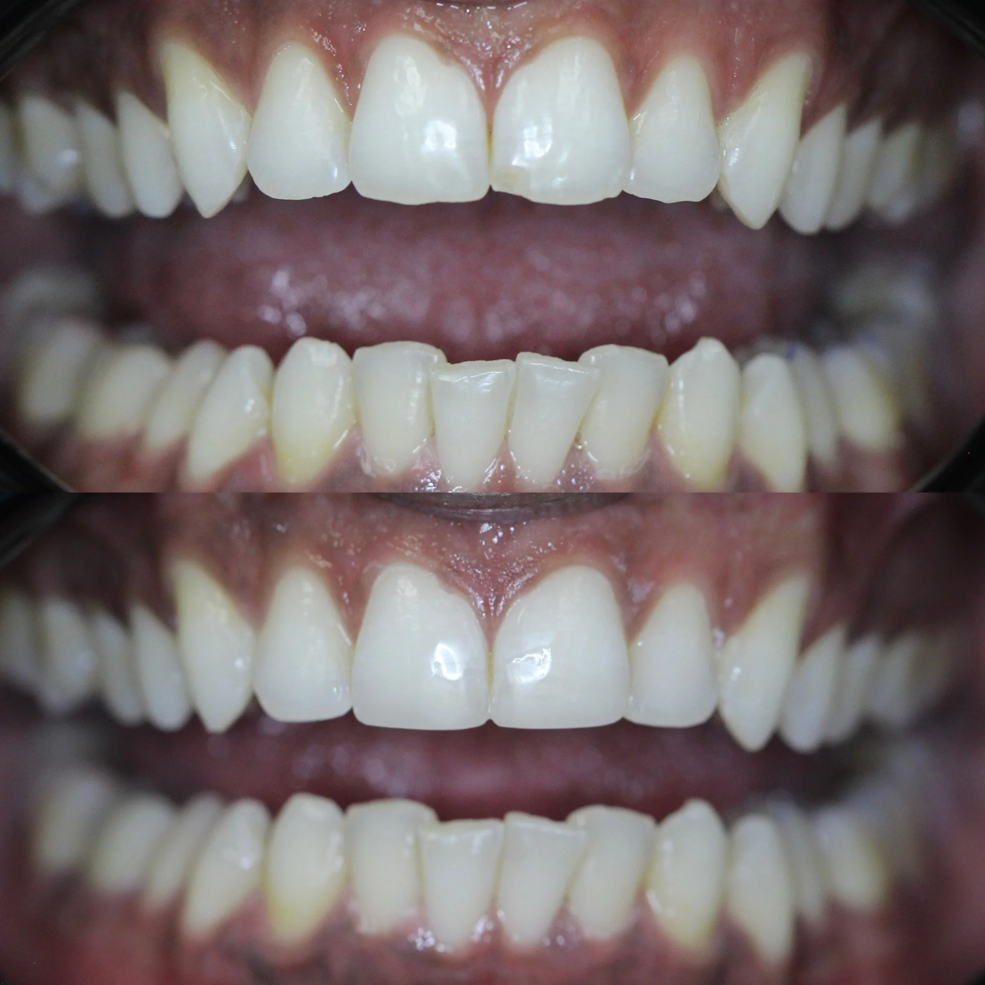 Close-up of a person's teeth showing before and after dental whitening treatments.