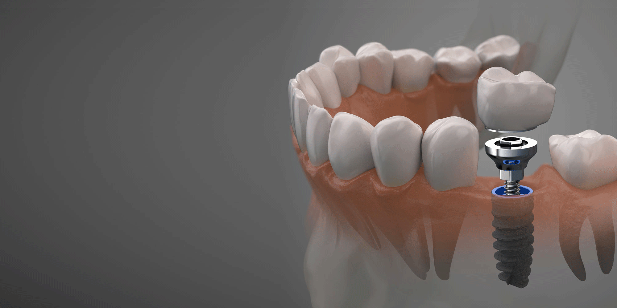 Dental implant procedure with artificial tooth being placed into the jawbone.