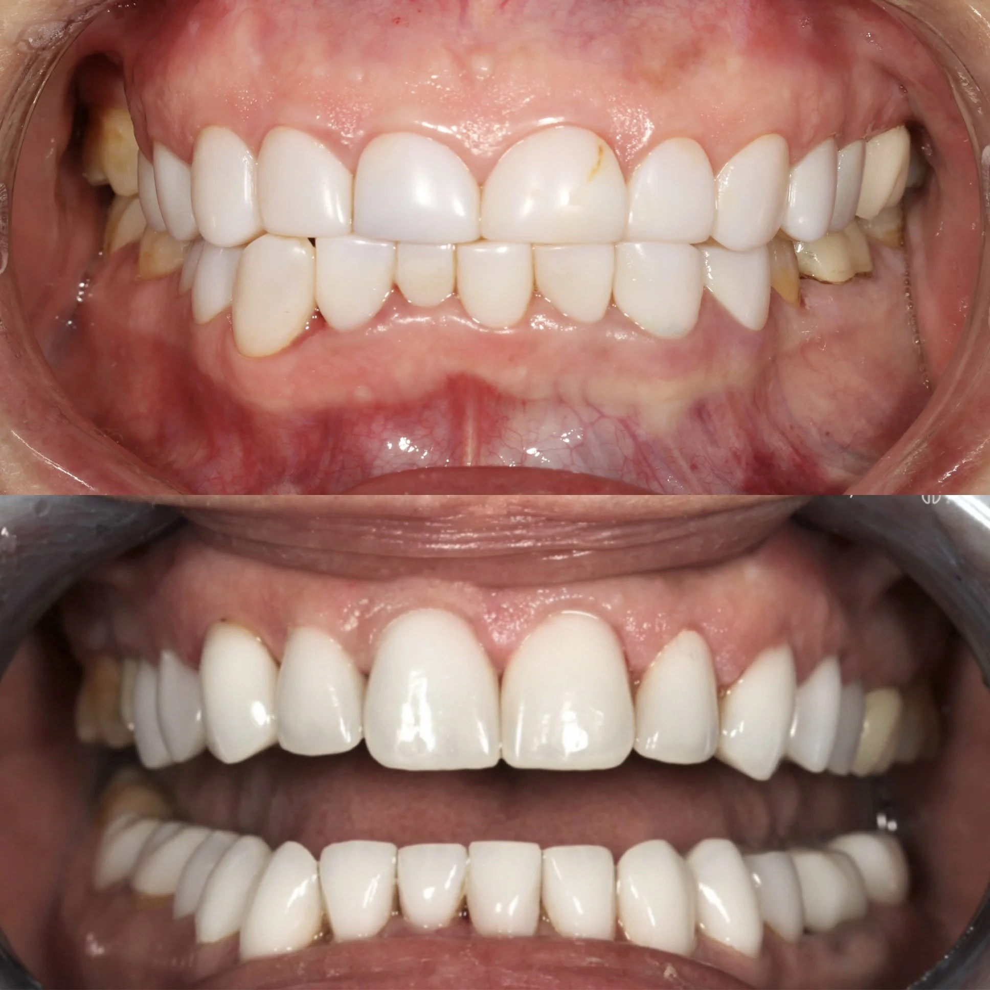 Close-up of a person's teeth before and after dental treatment, showing improved alignment and whiteness.