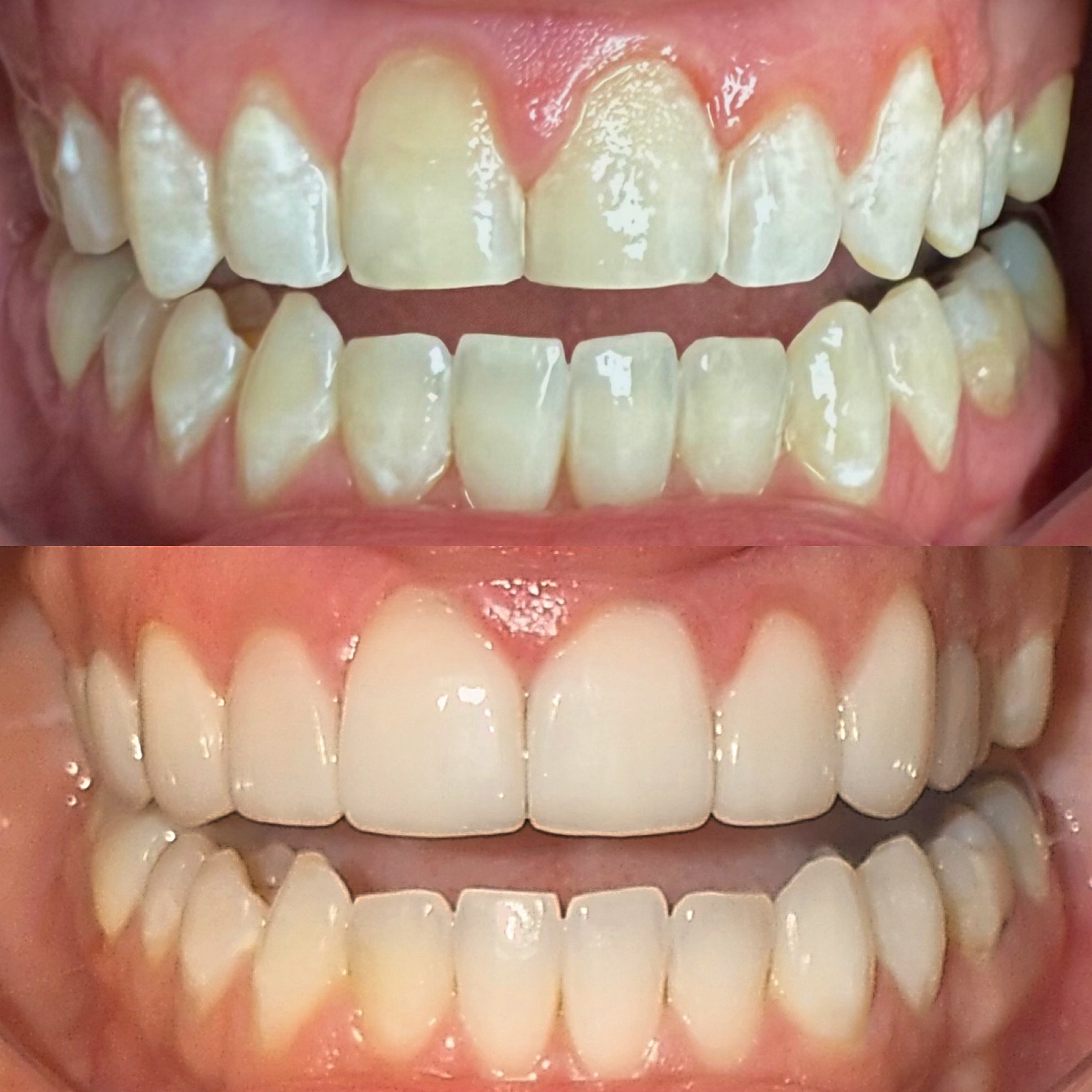 Comparison of teeth before and after dental treatment showing improved alignment and whitening.
