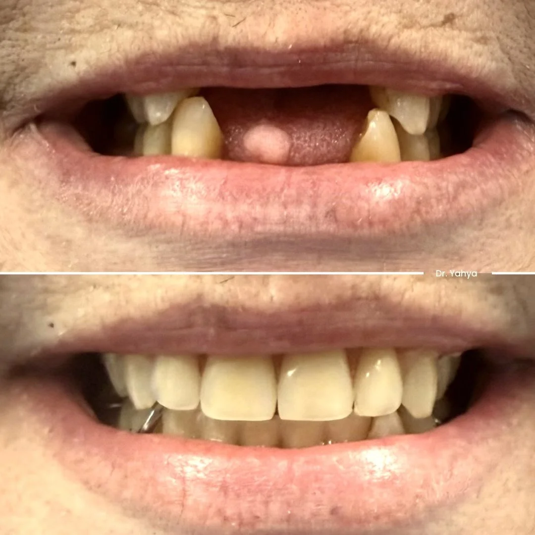 Comparison of a person's teeth before and after dental treatment showing significant improvement in dental appearance.