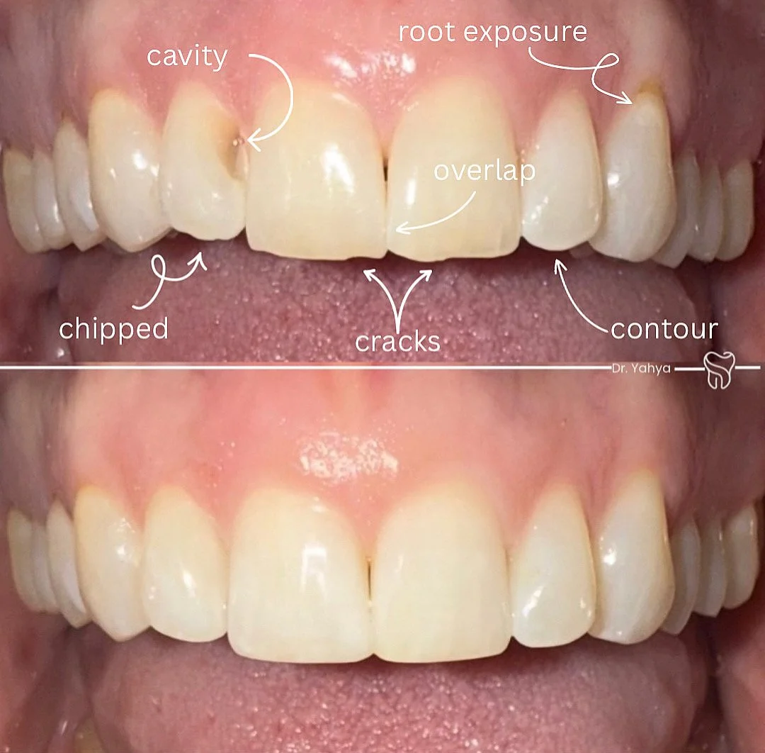 Close-up of teeth showing dental issues with labels pointing to the cavity, chips, cracks, root exposure, contour, and overlap, and a healthy set of teeth below for comparison.