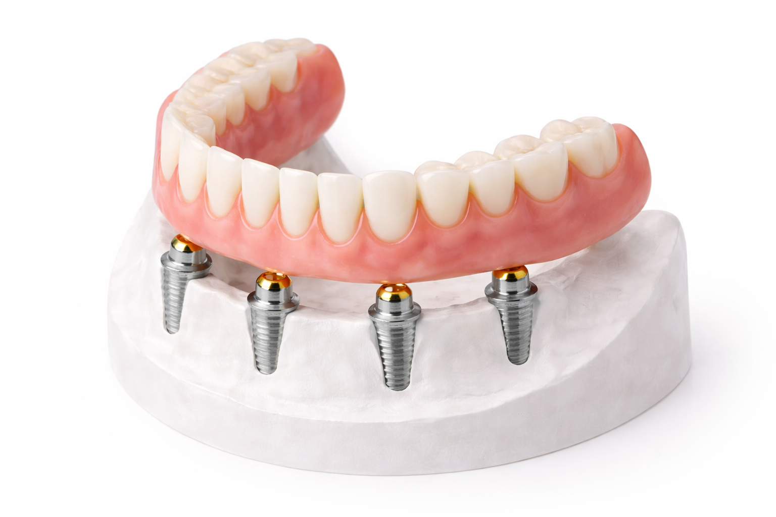 Implant Dentures