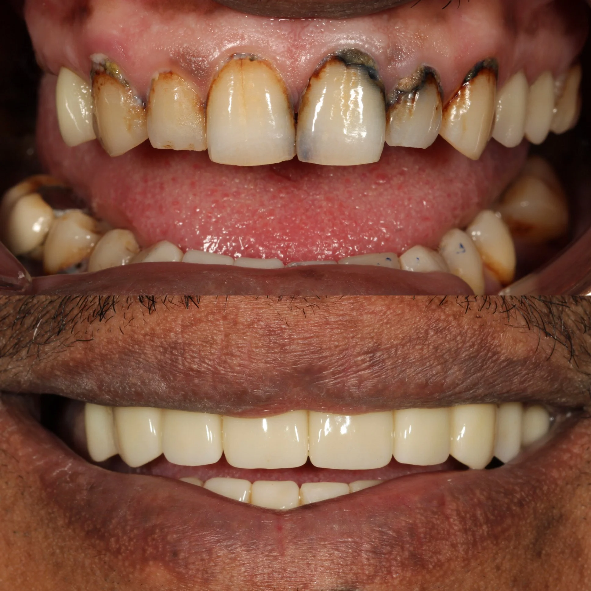 A before-and-after comparison of a person's teeth, showing significant dental improvement, including cleaner, whiter teeth in the after image.