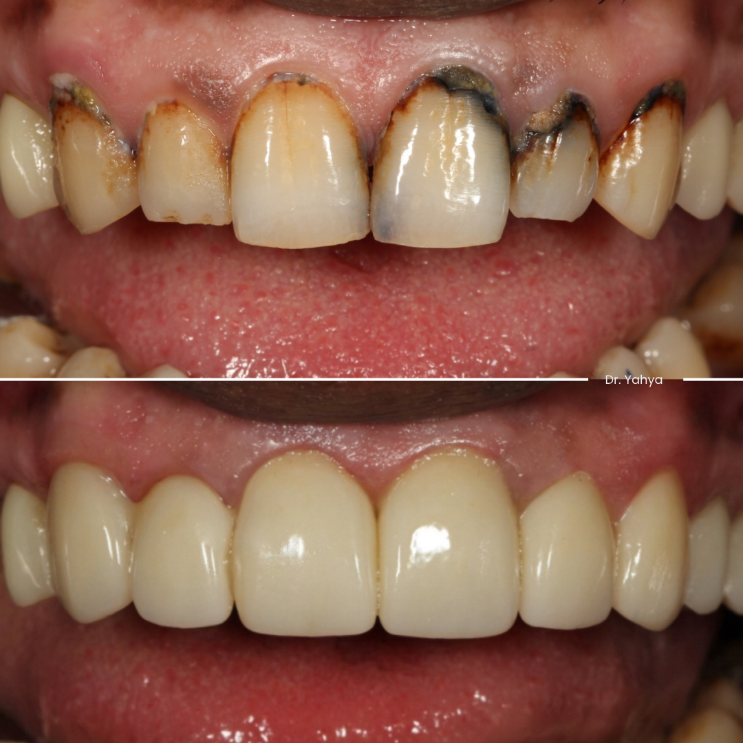 Comparison of teeth before and after dental cleaning, showing removal of stains and decay.