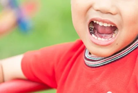 Stainless Steel Crowns