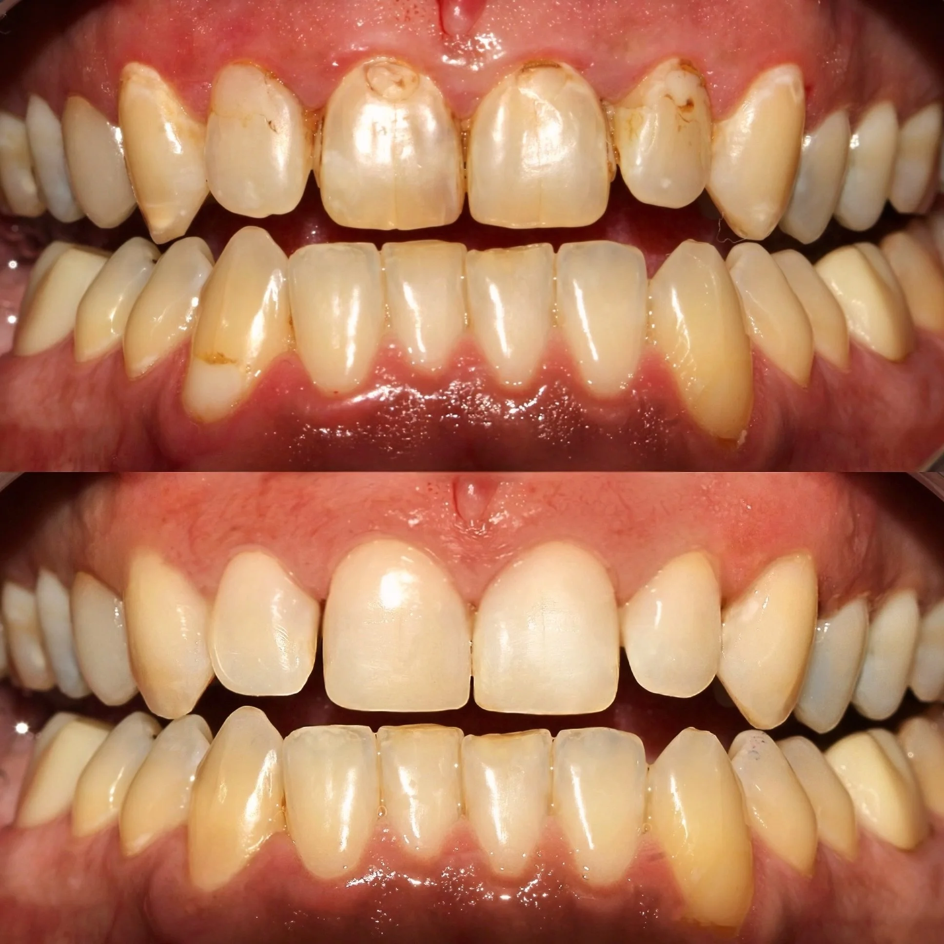 Comparison of teeth before and after dental cleaning or whitening, showing removal of stains and plaque.