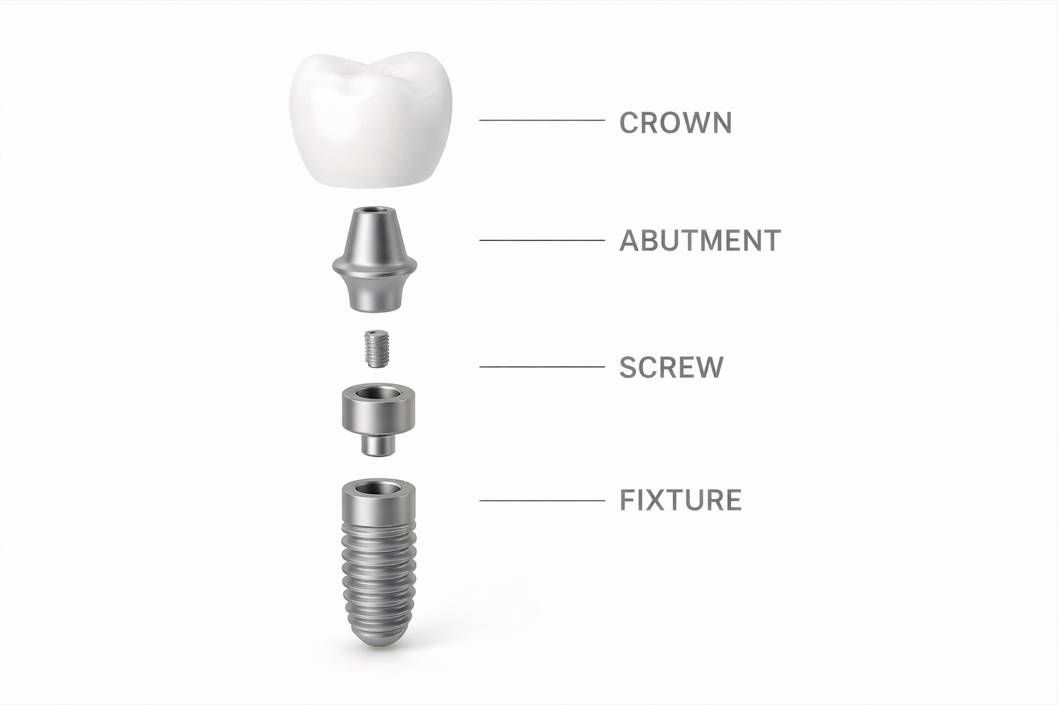 Diagram of a dental implant showing the components: crown on top, abutment below it, screw, and the fixture at the bottom, all labeled.