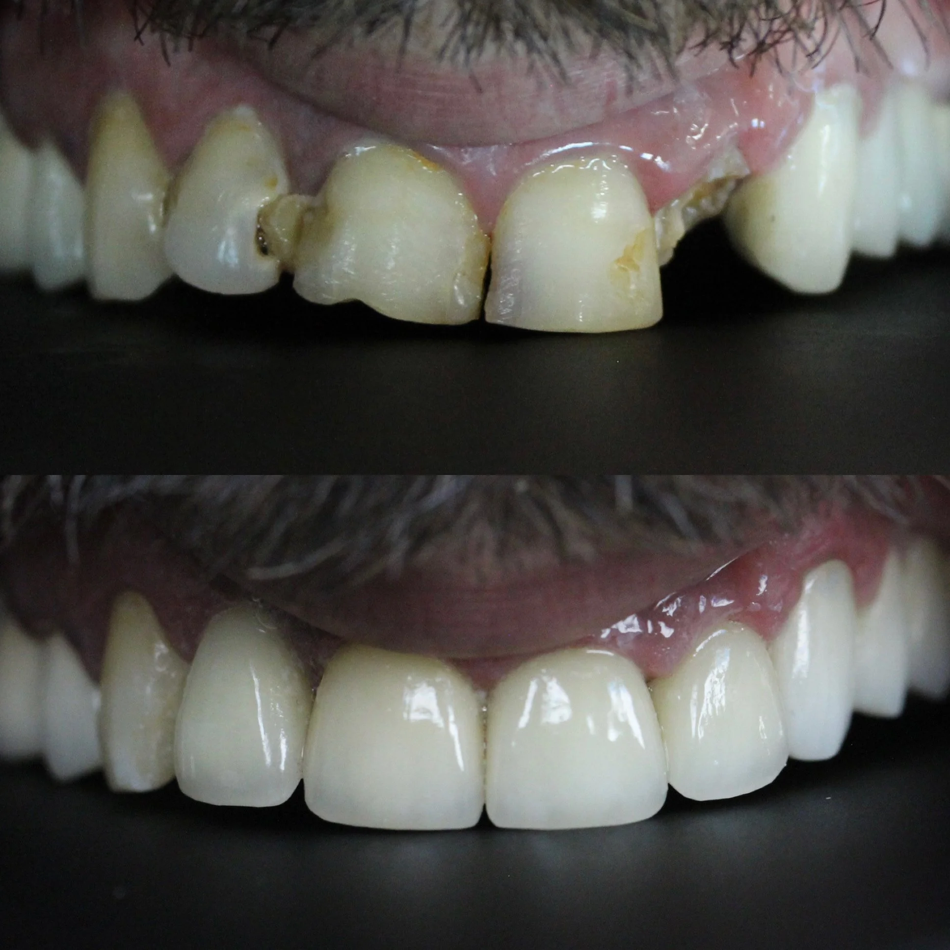 Close-up photo of a person's upper front teeth, showing before and after dental restoration, with the lower part displaying a healthier, more even smile.