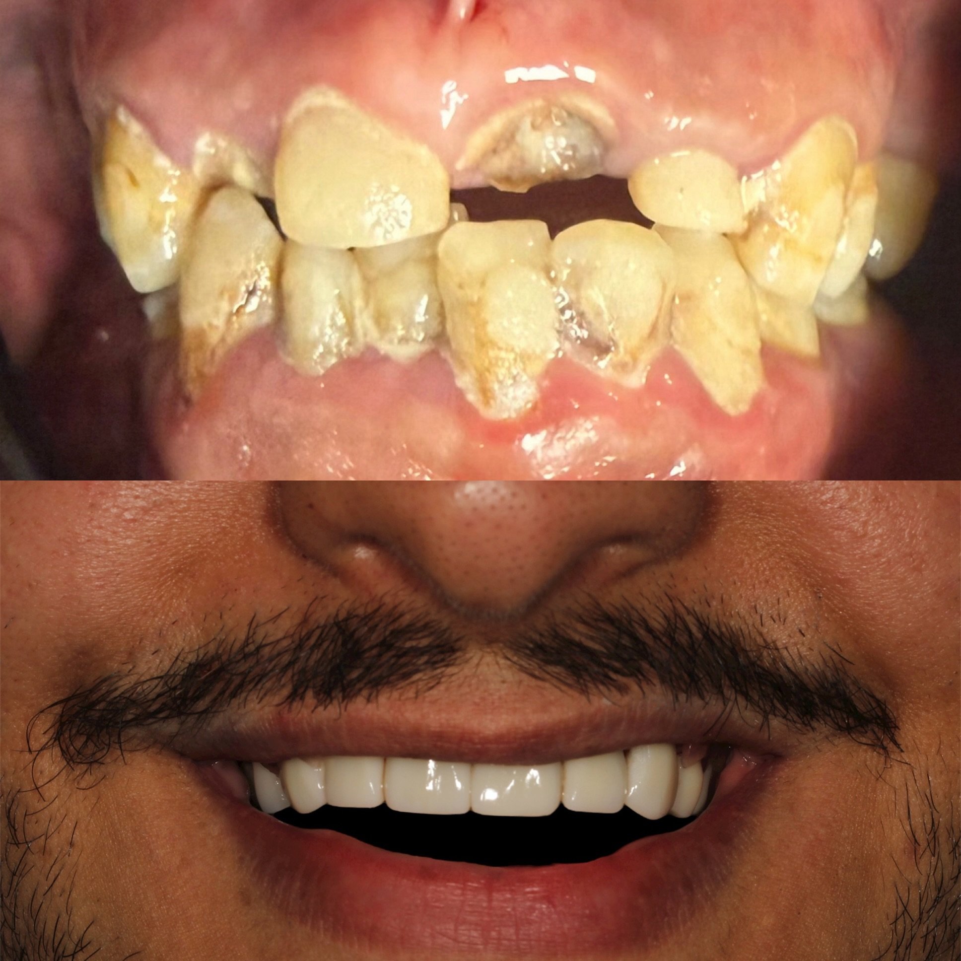 Comparison of teeth before and after dental treatment. The top image shows severely decayed and discolored teeth; the bottom image shows a smile with clean, white, and well-aligned teeth.