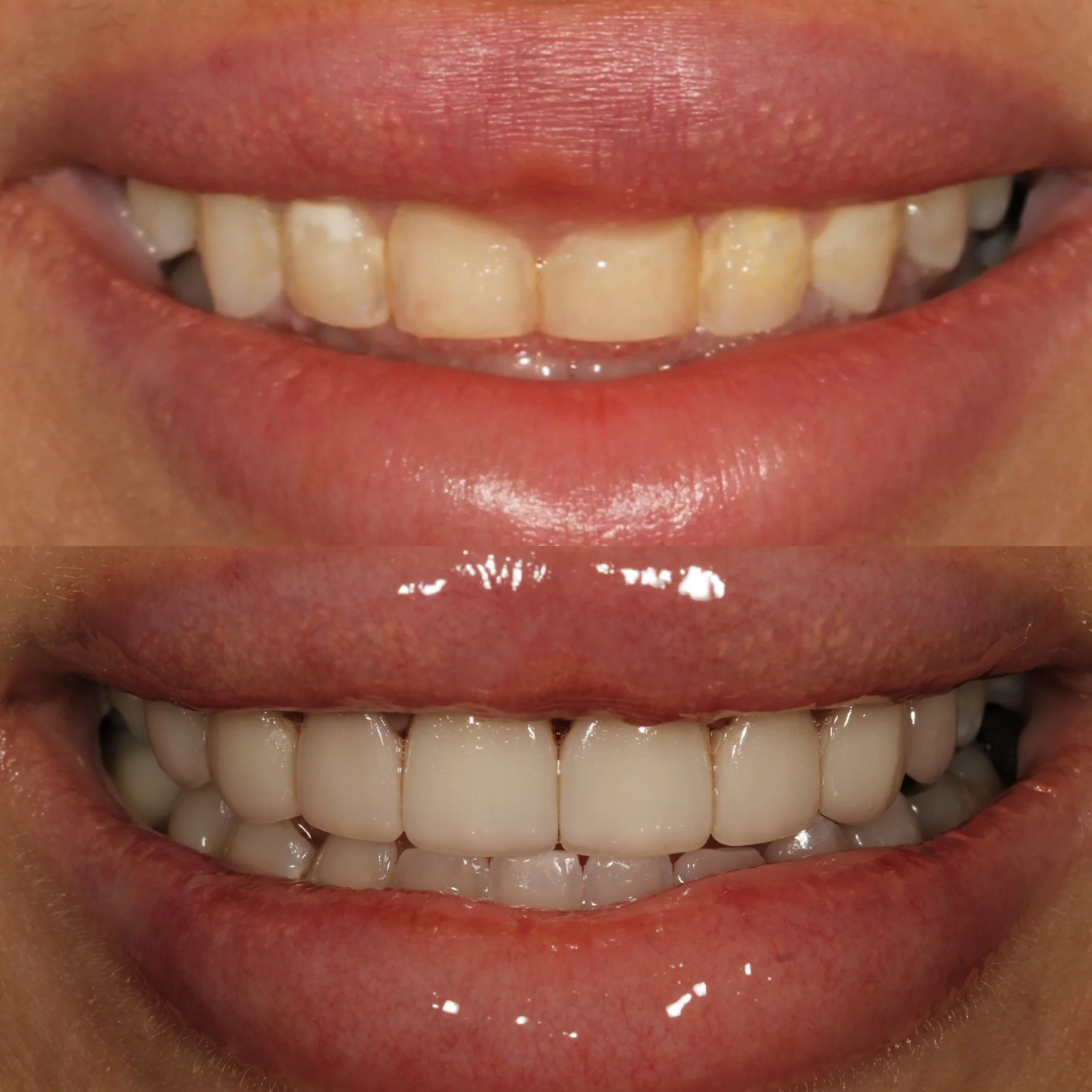 Comparison of a person's teeth before and after dental treatment, showing improved appearance after whitening or restorations.