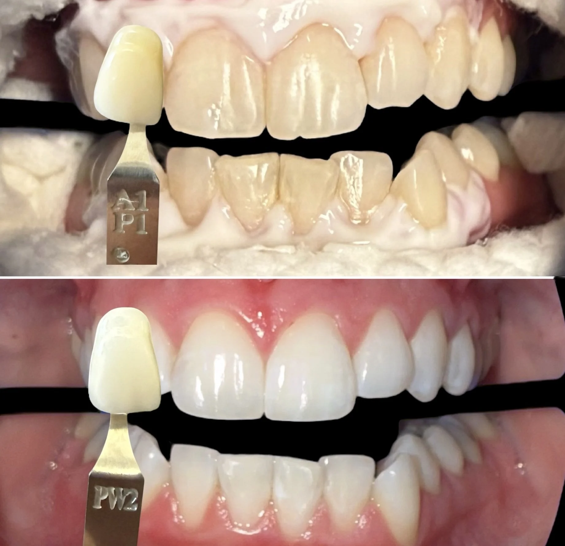 Comparison of teeth before and after whitening with shade guide, showing improved whiteness.