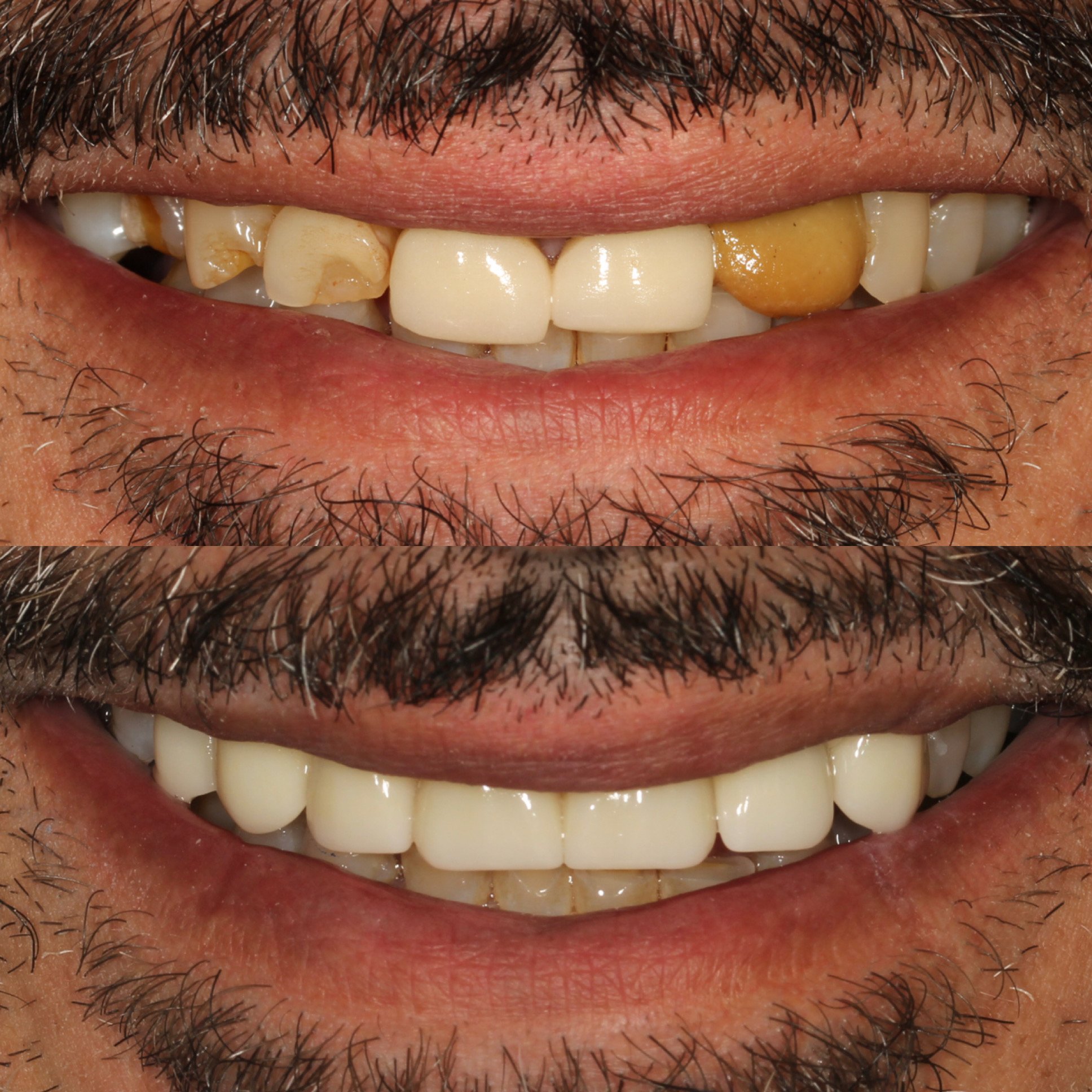 Comparison of a person's teeth before and after dental treatment, showing improved dental health and appearance.