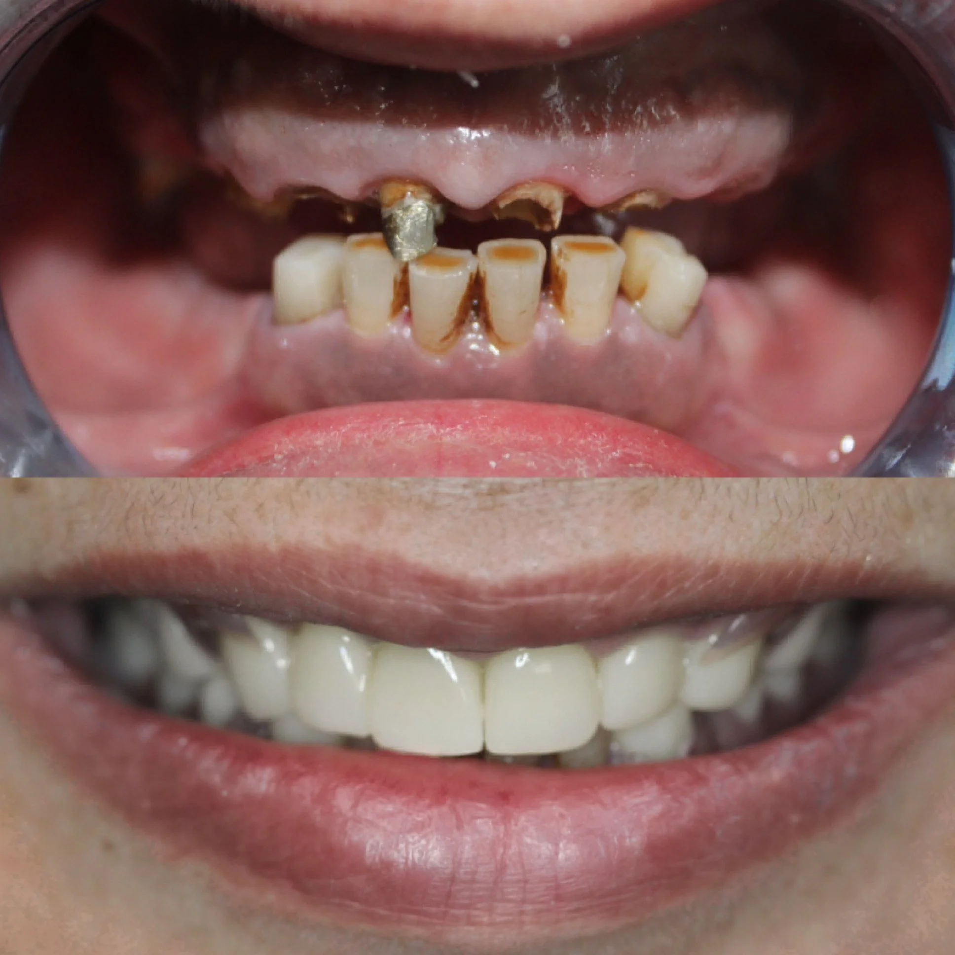 Comparison of a person's teeth before and after dental treatment shows significantly improved appearance, cleanliness, and health.