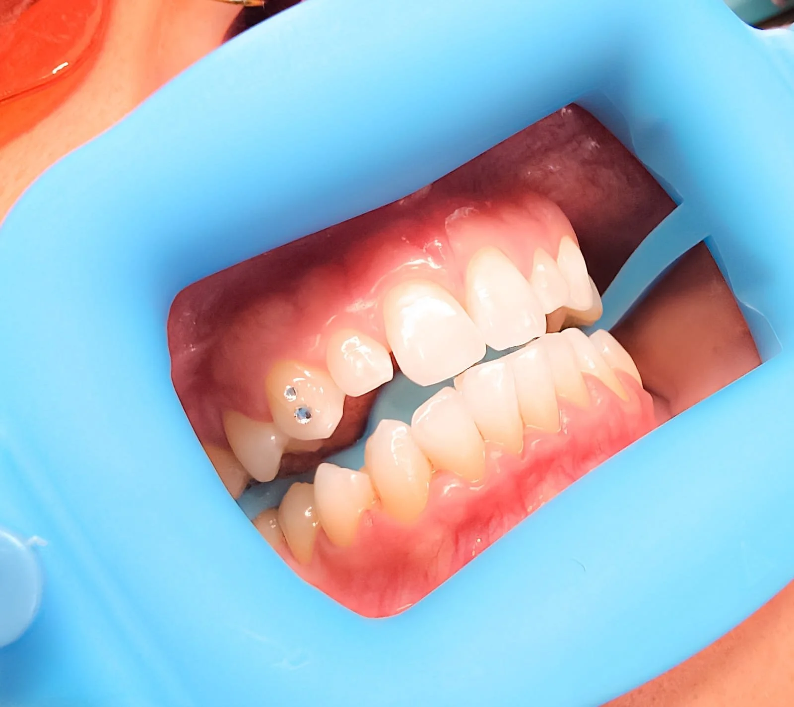 Swarovski Diamond Tooth Gem