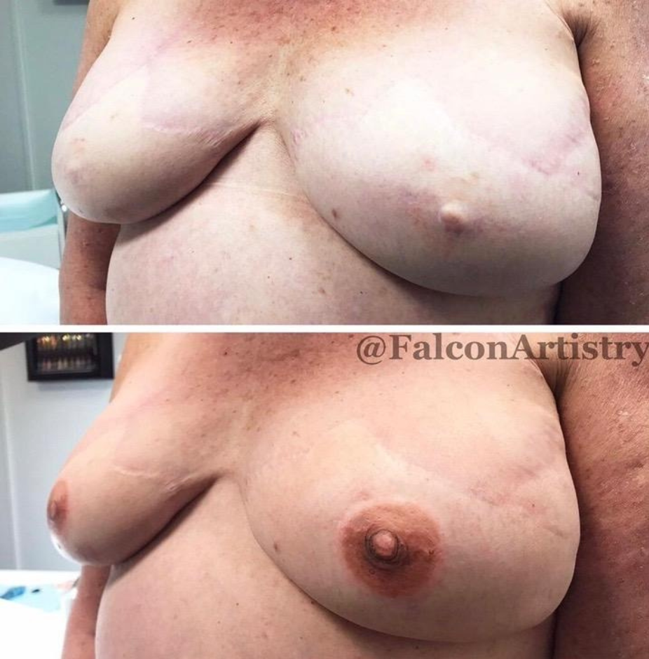 1st session 3D appearance nipple tattoos to even out the appearance of the
projection of the nipple on each side