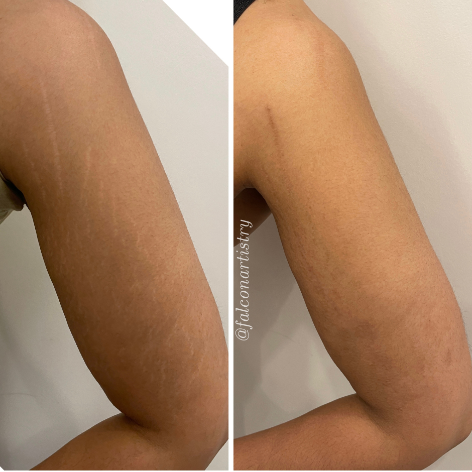 Stretchmark-camo-portfolio-copy (2).png