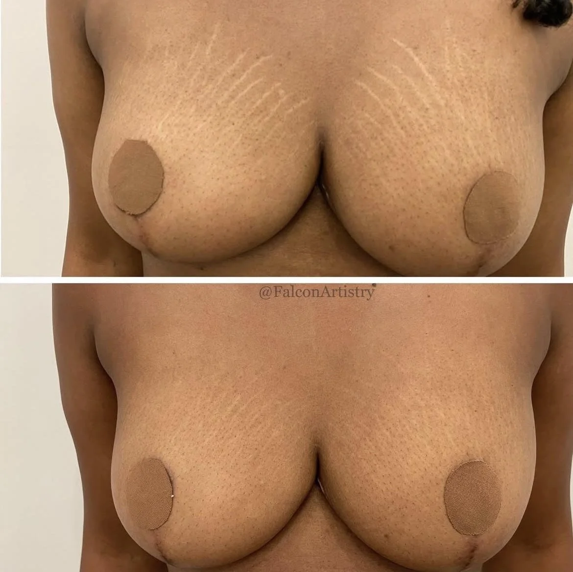 unnamed (2)-stretchmarks.jpg