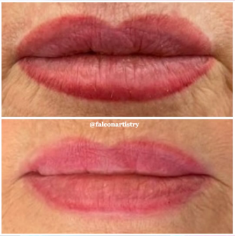 lips-saline.png