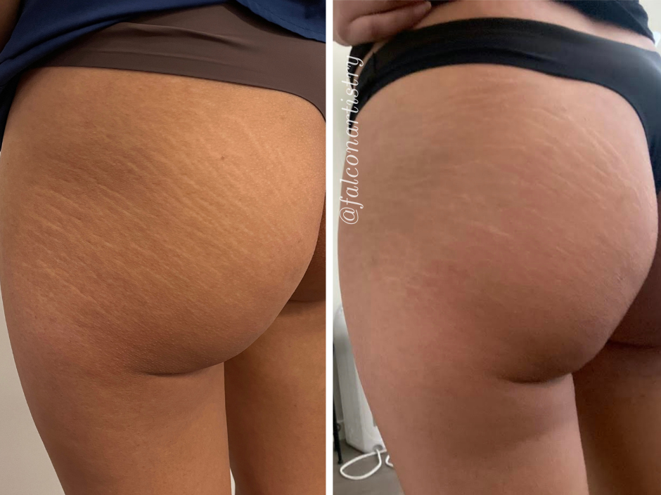 stretchmark-camo-portfolio-copy (5).png