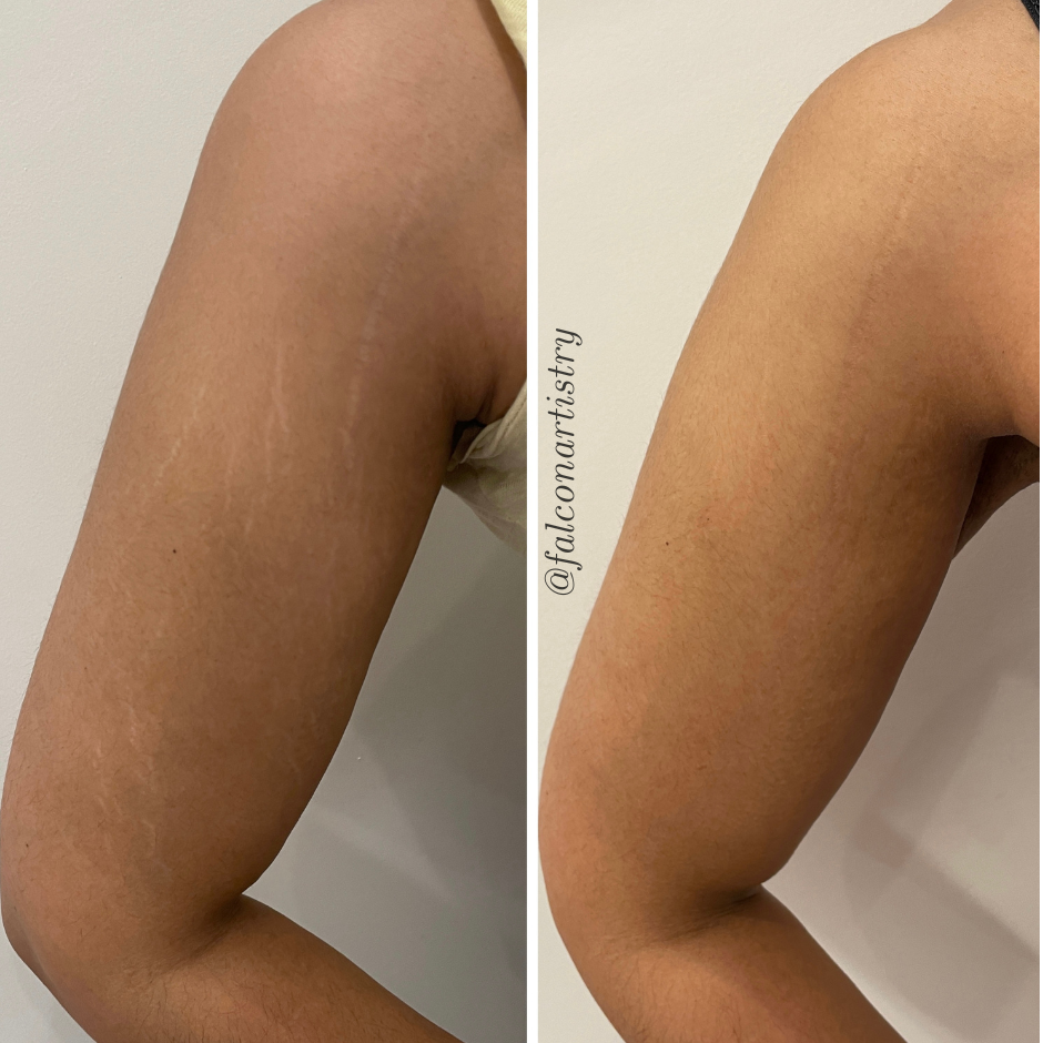 Stretchmark-camo-portfolio-copy (3).png