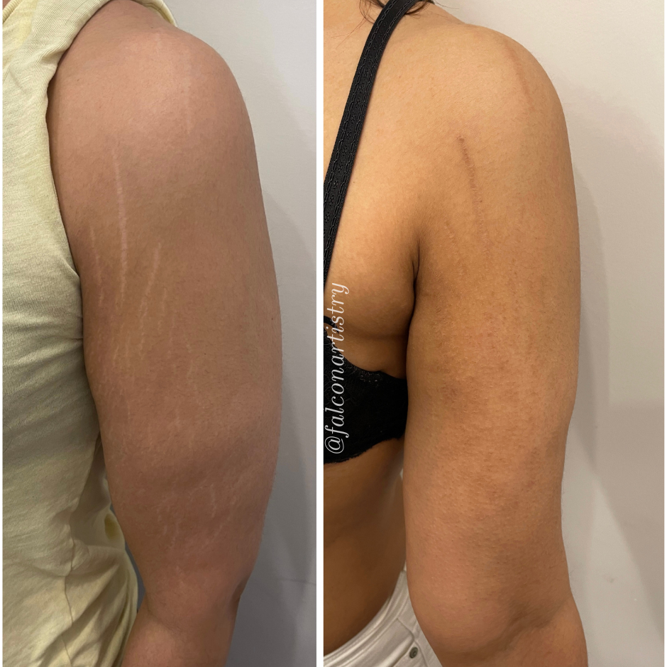 Stretchmark-camo-portfolio-copy.png