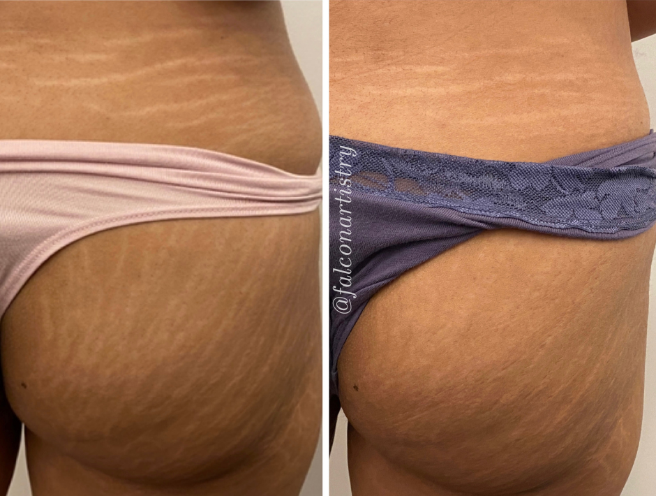 stretchmark-camo-portfolio-copy (4).png