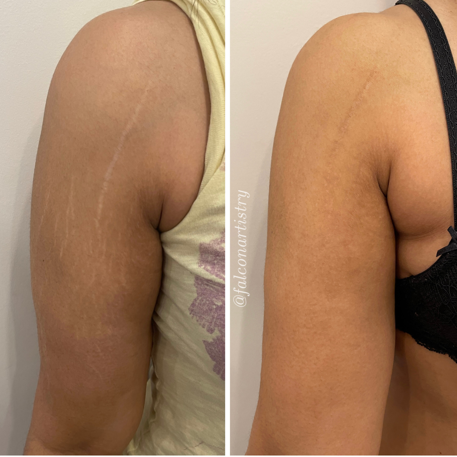 Stretchmark-camo-portfolio-copy (1).png