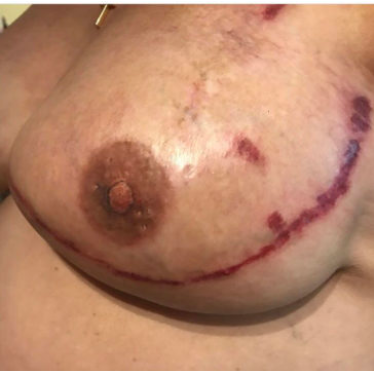 Julie-NippleTattoos2session (1).png