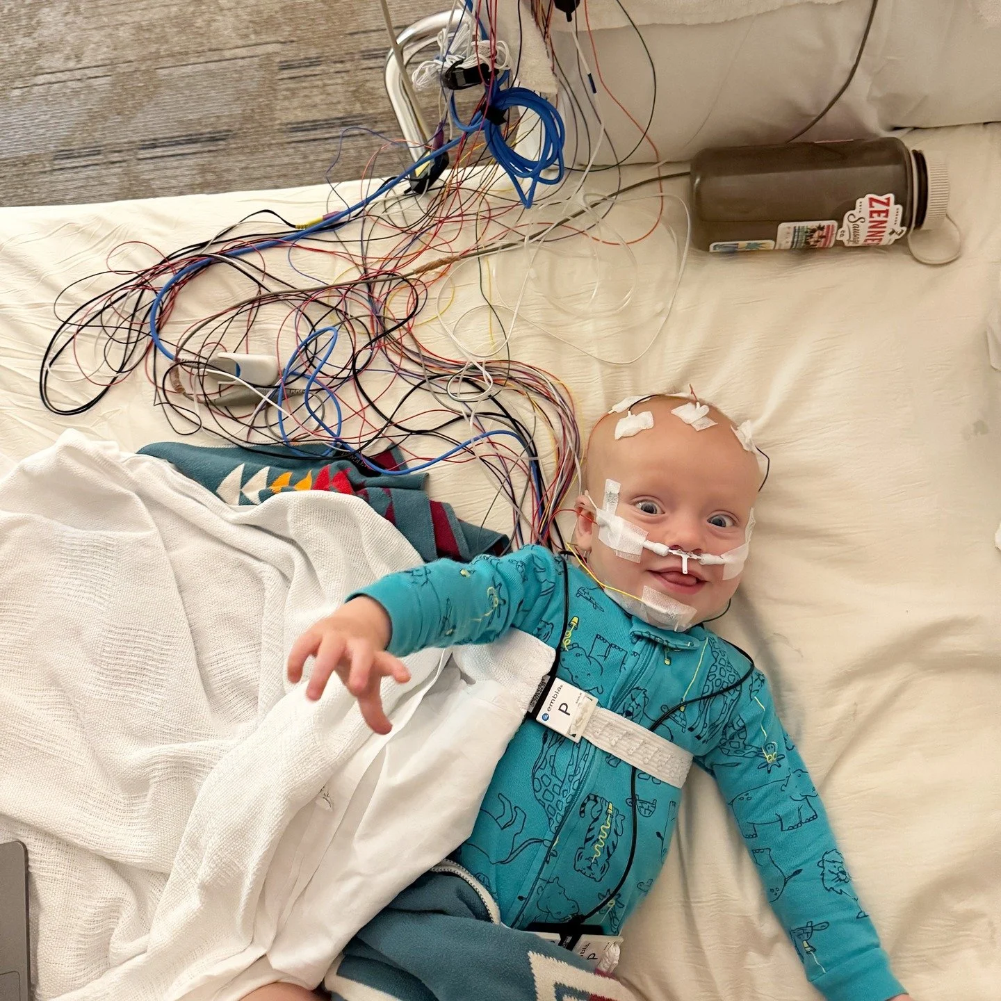 Mixed Sleep Apnea, Adenotonsillectomy &amp; PURA Syndrome

How we were able to obtain a diagnosis for mixed sleep apnea&hellip; A referral from our primary care physician to a neurologist. Our neurologist referred us to a sleep study clinic. Results 