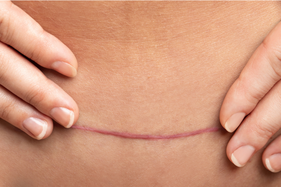 picture of c-section scar. scar tissue adhesions causing pain and restrictions post abdominal or pelvic surgery. c-section recovery, abdominal surgery recovery, prolapse surgery rehab, bladder surgery, scar tissue mobilization, scar tissue management