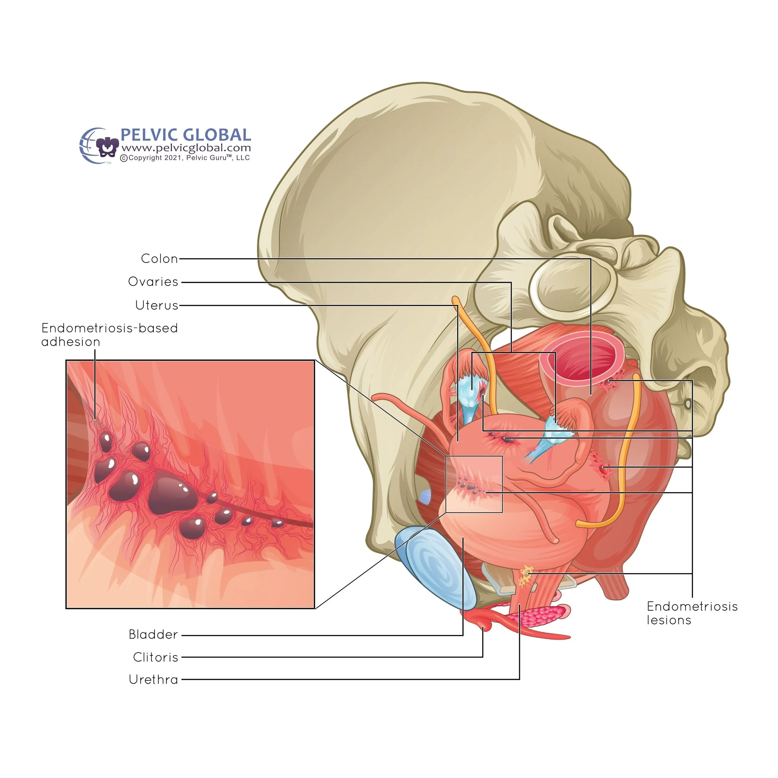 illustration from pelvic global academy with endometriosis present around the pelvic region including the bladder, uterus, fallopian tubes, ovaries, and rectum likely causing pain from endo