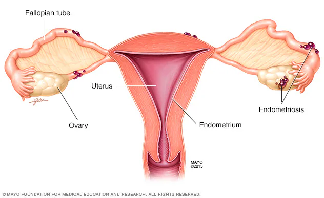 mayo foundation illustration of a uterus with endometriosis present on the ovaries and fallopian tubes