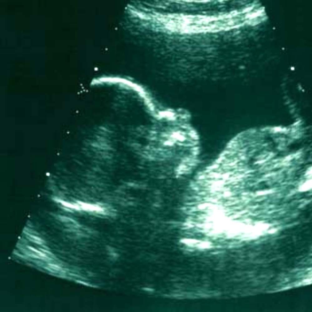 Ultraschallbild eines ungeborenen Babys im Mutterleib.