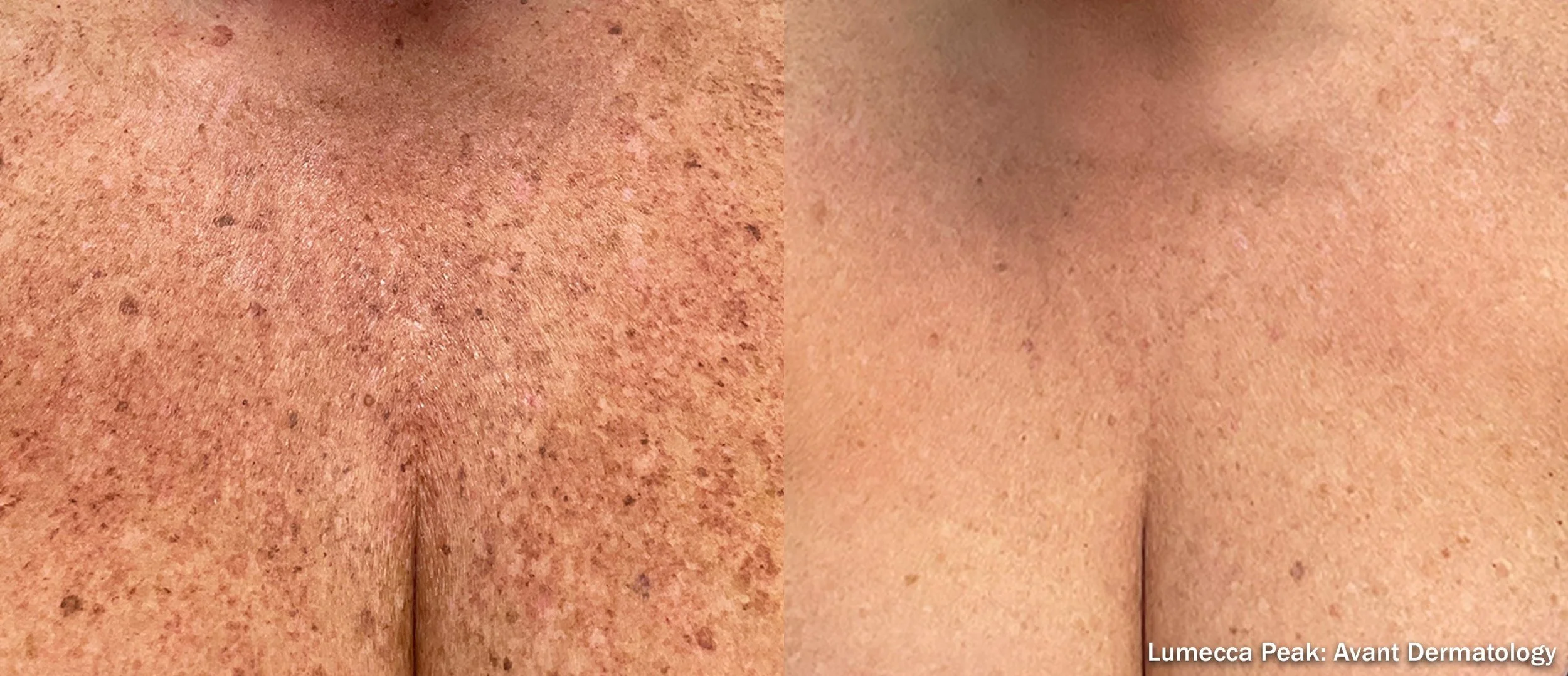 Before and after of Lumecca IPL