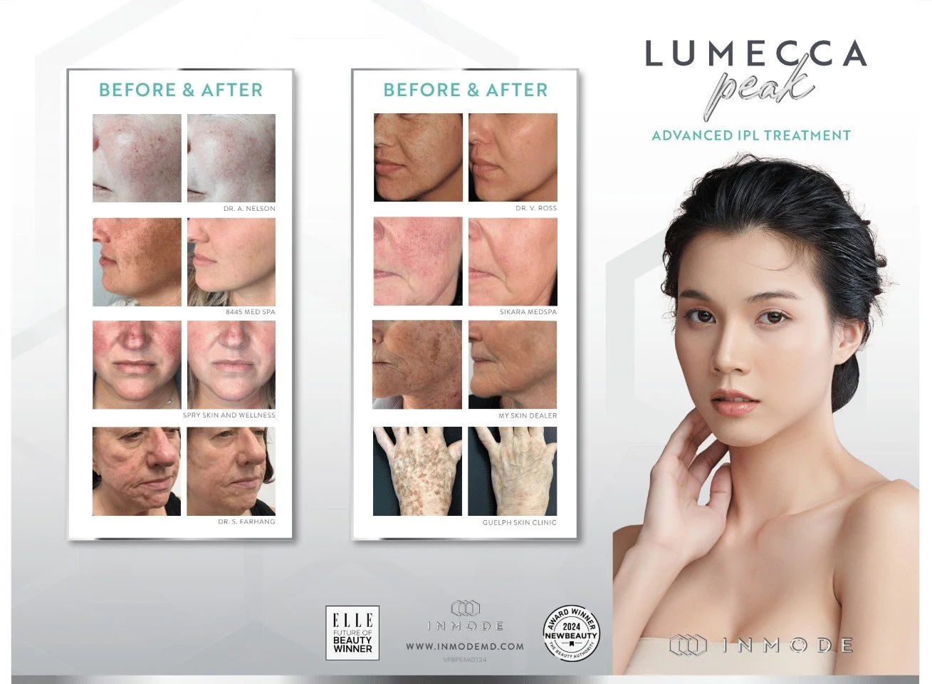 Advertisement for Lumeca Peak advanced IPL treatment featuring before and after photos of skin improvements on various individuals, including reduction of redness, pigmentation, and age spots.