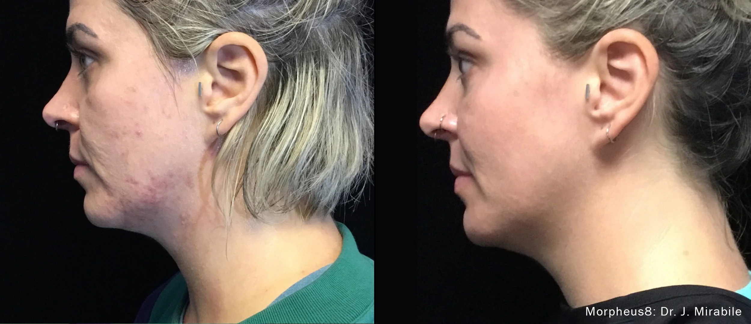 Before and after resurfacing with Morpheus 8