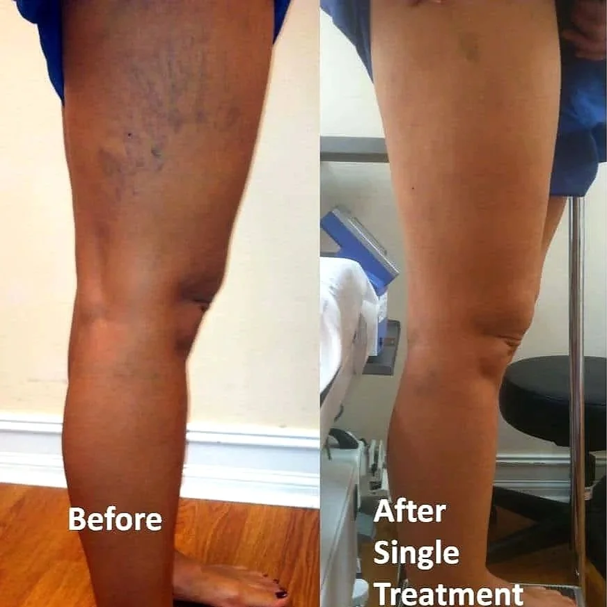 spider-vein-before-after-21.jpg