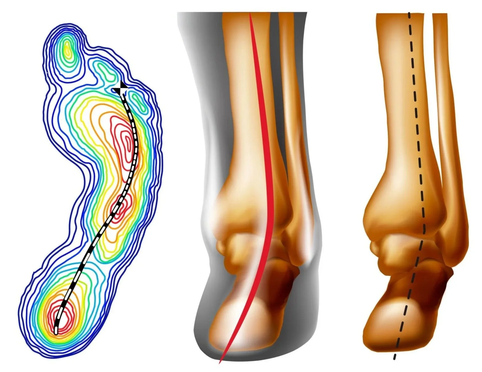 Flat feet vs normal arch comparison with foot pressure map and alignment analysis